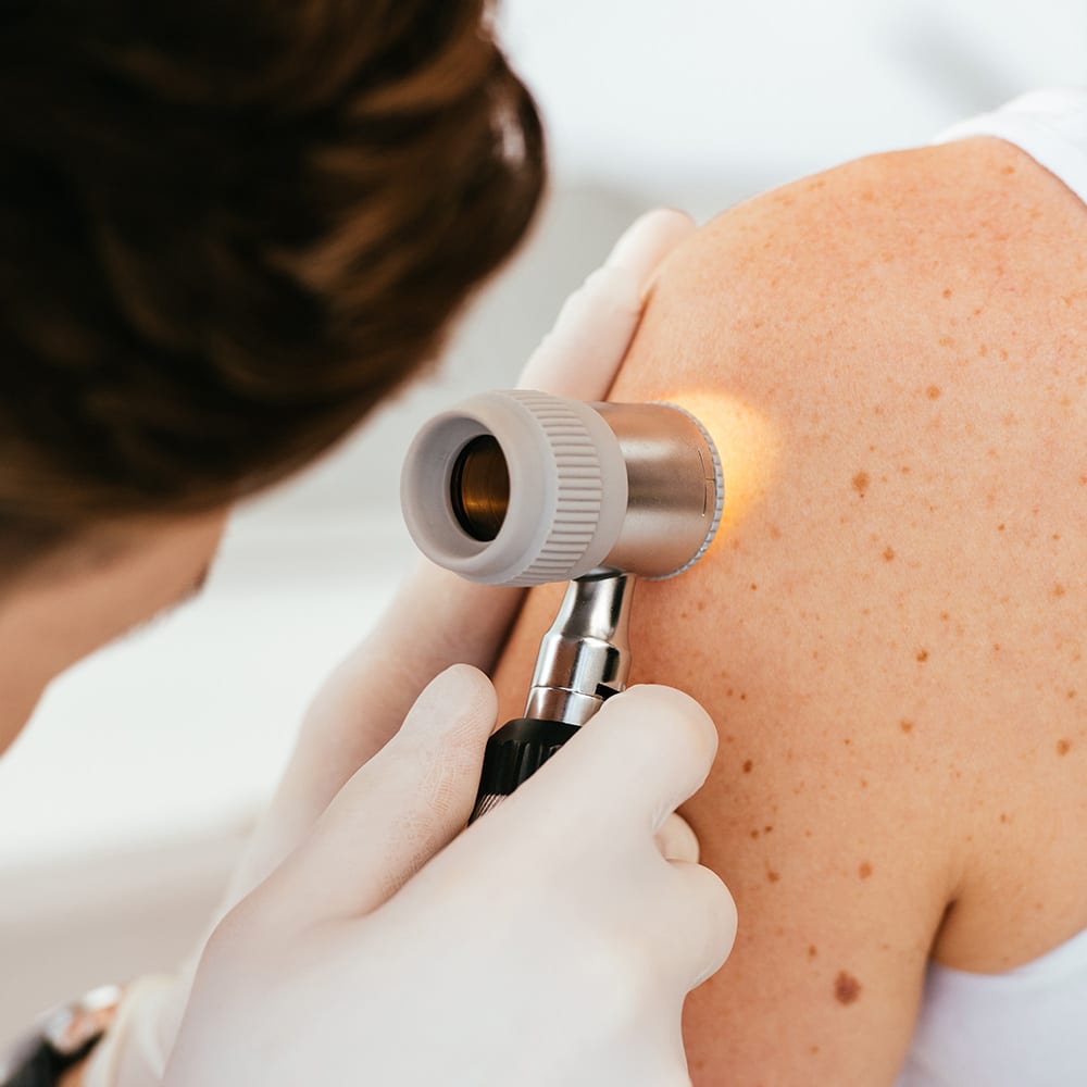 melanome c est quoi docteur arnaud petit chirurgien dermatologique specialiste cancer de la peau lesions cutanees cicatrices chirurgie dermatologique paris
