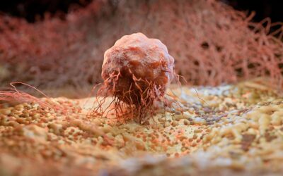 Carcinome basocellulaire infiltrant, ce qu’il faut savoir