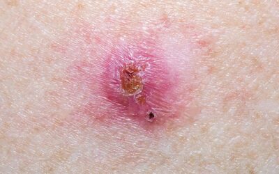 Carcinome basocellulaire et métastase