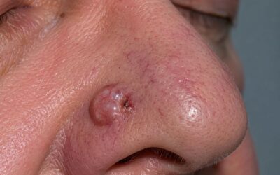 Carcinome basocellulaire : quels symptômes ?
