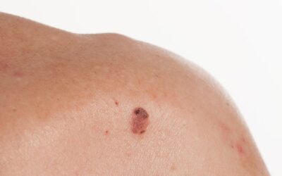 Grain de beauté gonflé et douloureux : est-ce un mélanome ?