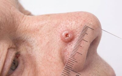 Reconnaître un carcinome épidermoïde au visage