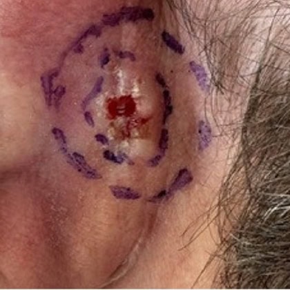 carcinome basocellulaire retro auriculaire gauche cicatrisation dr arnaud petit chirurgien esthetique paris 1