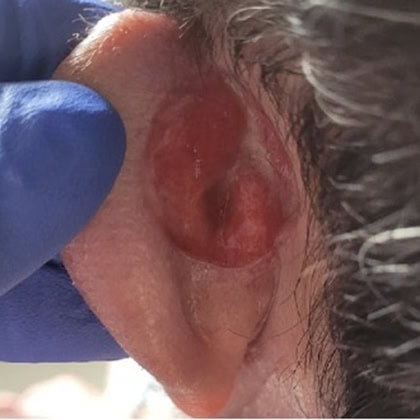 carcinome basocellulaire retro auriculaire gauche cicatrisation dr arnaud petit chirurgien esthetique paris 3