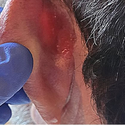 carcinome basocellulaire retro auriculaire gauche cicatrisation dr arnaud petit chirurgien esthetique paris 4