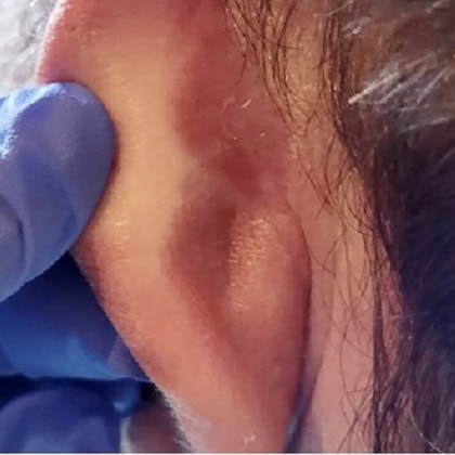 carcinome basocellulaire retro auriculaire gauche cicatrisation dr arnaud petit chirurgien esthetique paris 5