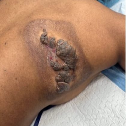 cas clinique dr arnaud petit exerese hamartome verruco sebace dorsal 1