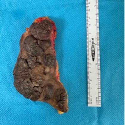 cas clinique dr arnaud petit exerese hamartome verruco sebace dorsal 2