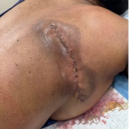 cas clinique dr arnaud petit exerese hamartome verruco sebace dorsal 3
