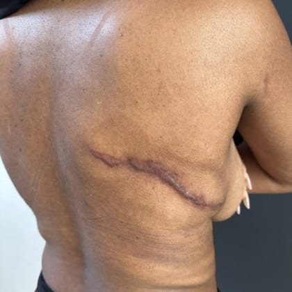 cas clinique dr arnaud petit exerese hamartome verruco sebace dorsal 4
