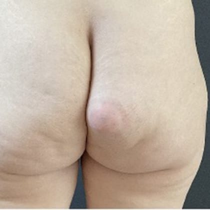 cas clinique dr arnaud petit exerese lipome fesse droite 1