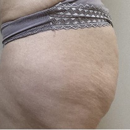 cas clinique dr arnaud petit exerese lipome fesse droite 10