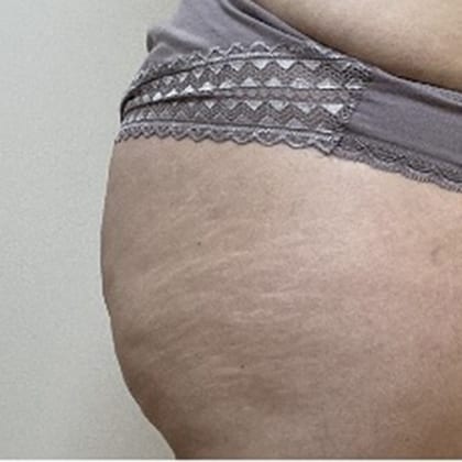 cas clinique dr arnaud petit exerese lipome fesse droite 11