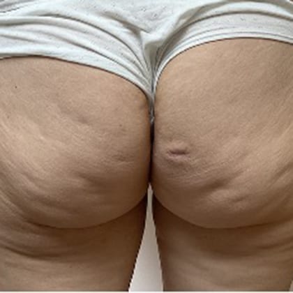 cas clinique dr arnaud petit exerese lipome fesse droite 12