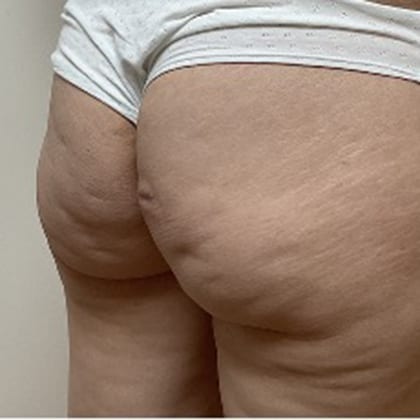 cas clinique dr arnaud petit exerese lipome fesse droite 13