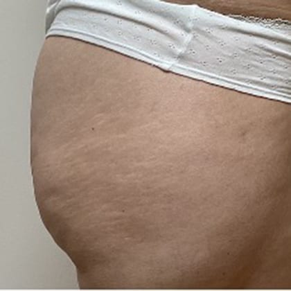 cas clinique dr arnaud petit exerese lipome fesse droite 14