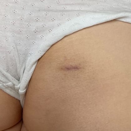 cas clinique dr arnaud petit exerese lipome fesse droite 15