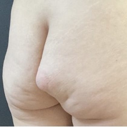 cas clinique dr arnaud petit exerese lipome fesse droite 2