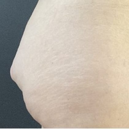 cas clinique dr arnaud petit exerese lipome fesse droite 3