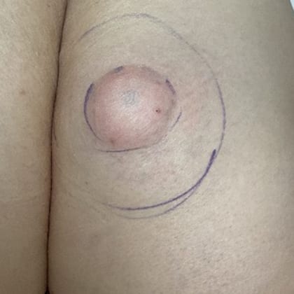cas clinique dr arnaud petit exerese lipome fesse droite 5