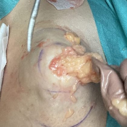 cas clinique dr arnaud petit exerese lipome fesse droite 6