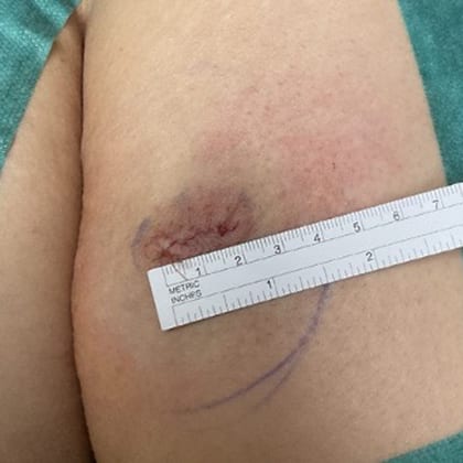 cas clinique dr arnaud petit exerese lipome fesse droite 8