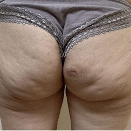 cas clinique dr arnaud petit exerese lipome fesse droite 9