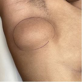 cas clinique lipome sous axillaire droit dr arnaud petit chirurgien esthetique paris 1