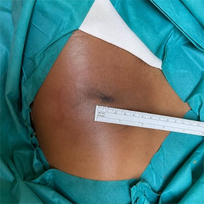 cas clinique lipome sous axillaire droit dr arnaud petit chirurgien esthetique paris 10