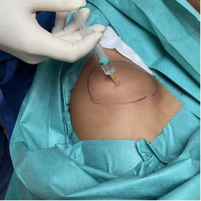 cas clinique lipome sous axillaire droit dr arnaud petit chirurgien esthetique paris 4