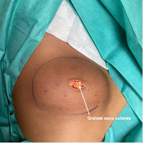 cas clinique lipome sous axillaire droit dr arnaud petit chirurgien esthetique paris 5