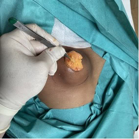 cas clinique lipome sous axillaire droit dr arnaud petit chirurgien esthetique paris 6