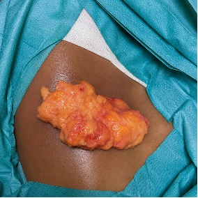 cas clinique lipome sous axillaire droit dr arnaud petit chirurgien esthetique paris 8