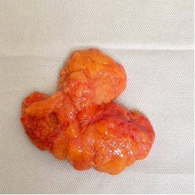 cas clinique lipome sous axillaire droit dr arnaud petit chirurgien esthetique paris 9