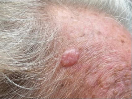 exerese carcinome basocellulaire nodulaire region temporale droite dr arnaud petit chirurgien esthetique paris 1