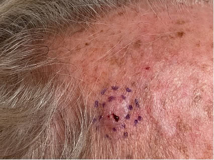exerese carcinome basocellulaire nodulaire region temporale droite dr arnaud petit chirurgien esthetique paris 2