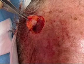 exerese carcinome basocellulaire nodulaire region temporale droite dr arnaud petit chirurgien esthetique paris 3