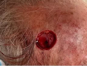 exerese carcinome basocellulaire nodulaire region temporale droite dr arnaud petit chirurgien esthetique paris 4
