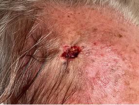 exerese carcinome basocellulaire nodulaire region temporale droite dr arnaud petit chirurgien esthetique paris 5