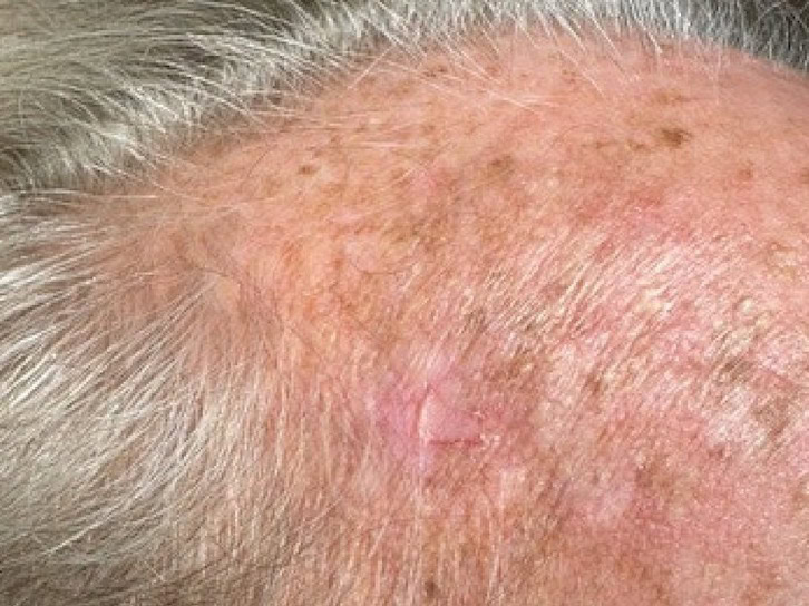 exerese carcinome basocellulaire nodulaire region temporale droite dr arnaud petit chirurgien esthetique paris 6