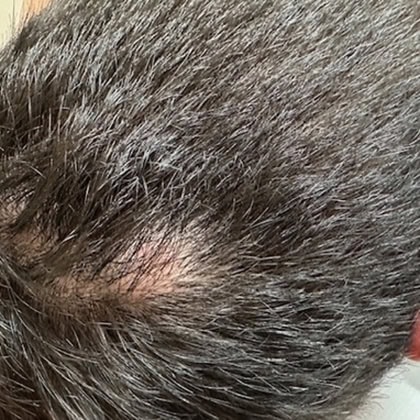 exerese kyste trichilemmal loupe cuir chevelu dr arnaud petit chirurgien esthetique paris 1
