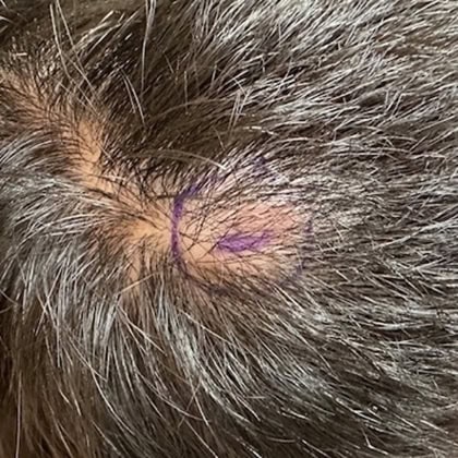 exerese kyste trichilemmal loupe cuir chevelu dr arnaud petit chirurgien esthetique paris 2