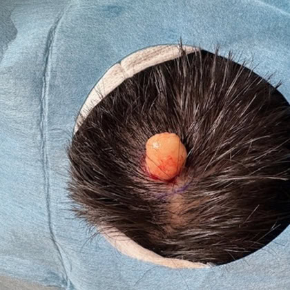 exerese kyste trichilemmal loupe cuir chevelu dr arnaud petit chirurgien esthetique paris 3