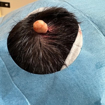 exerese kyste trichilemmal loupe cuir chevelu dr arnaud petit chirurgien esthetique paris 4