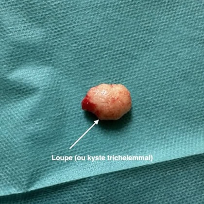 exerese kyste trichilemmal loupe cuir chevelu dr arnaud petit chirurgien esthetique paris 5