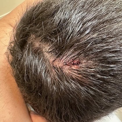exerese kyste trichilemmal loupe cuir chevelu dr arnaud petit chirurgien esthetique paris 6