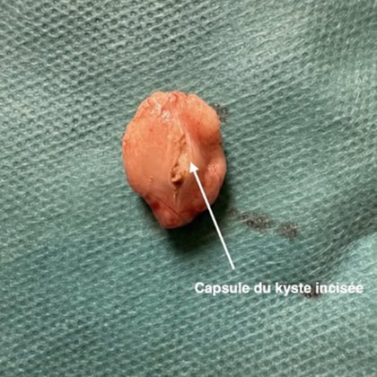 exerese kyste trichilemmal loupe cuir chevelu dr arnaud petit chirurgien esthetique paris 7