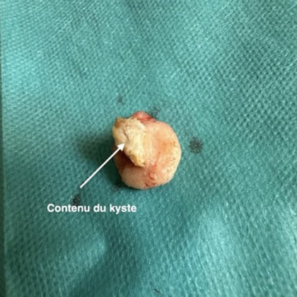 exerese kyste trichilemmal loupe cuir chevelu dr arnaud petit chirurgien esthetique paris 8