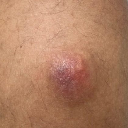 exerese pilomatricome mollet droit dr arnaud petit chirurgien dermatologique paris 1