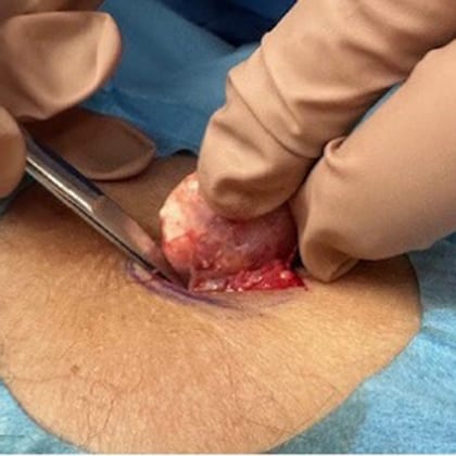 exerese pilomatricome mollet droit dr arnaud petit chirurgien dermatologique paris 2